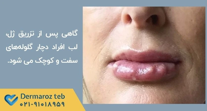 عوارض تزریق ژل لب