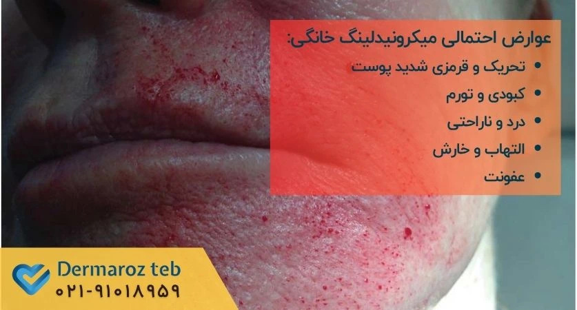 عوارض میکرونیدلینگ