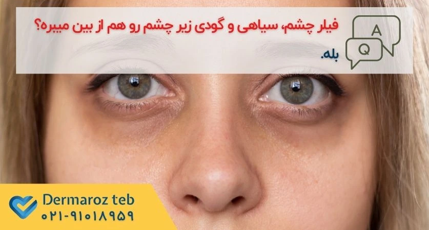 فیلر زیر چشم برای رفع گودی و تیرگی