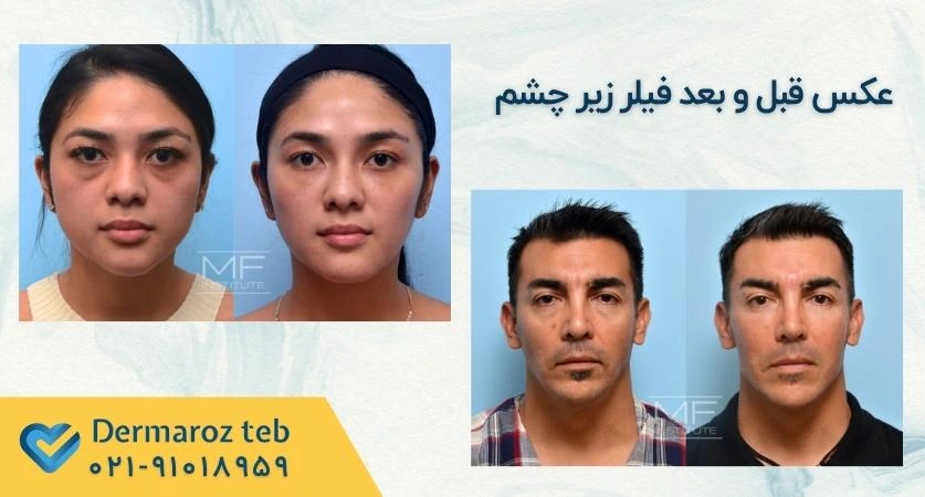 عکس فیلر زیر چشم قبل و بعد