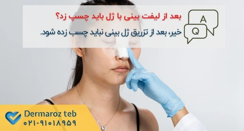 چسب زدن بینی بعد از لیفت با ژل