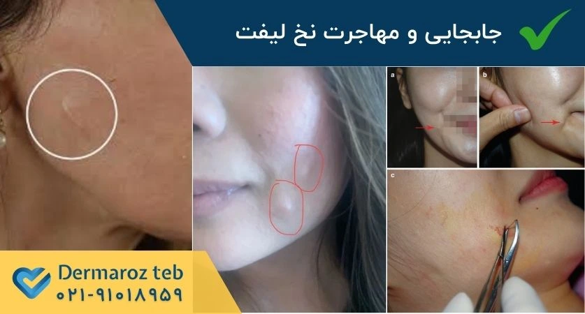 مهاجرت نخ لیفت