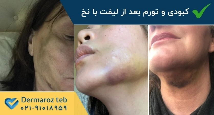 تورم و کبودی ناشی از لیفت صورت با نخ