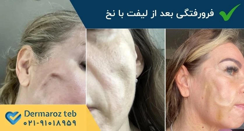 فرورفتگی یا گودی بعد از لیفت با نخ