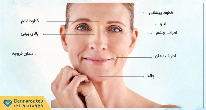 بوتاکس نواحی مختلف صورت