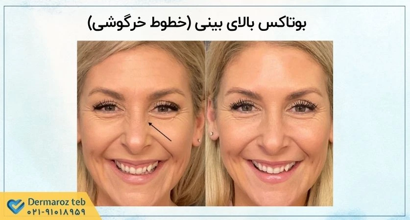 بوتاکس بالای بینی خطوط خرگوشی