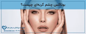 بوتاکس چشم گربه ای