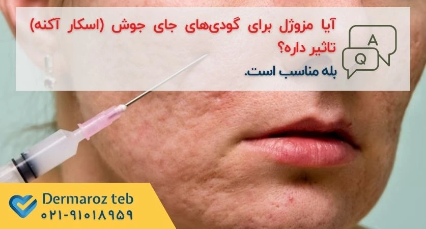 کاربرد مزوژل برای اسکار جوش