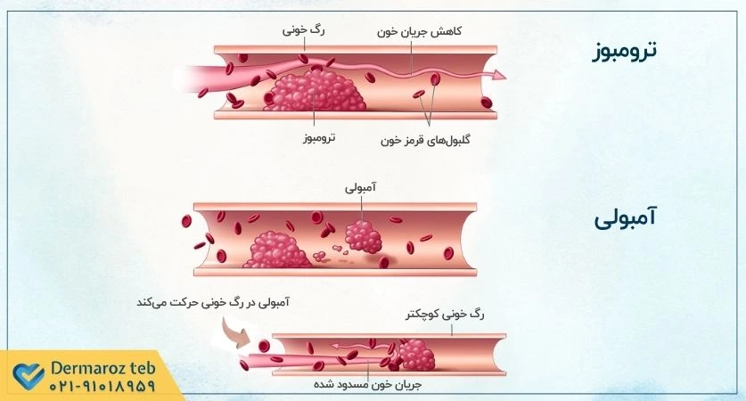 ترومبوز چقدر رایج و خطرناک است؟