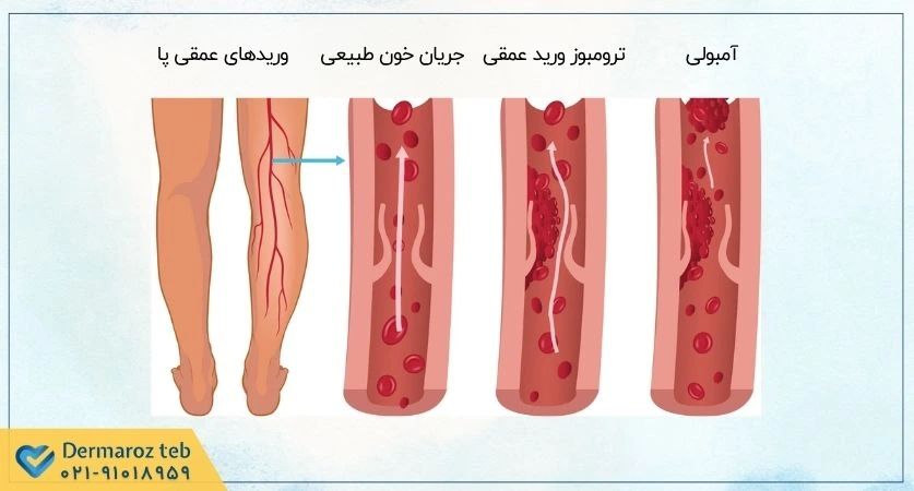 فاکتورهای افزایش ریسک ترومبوز