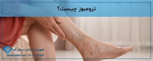 ترومبوز چیست