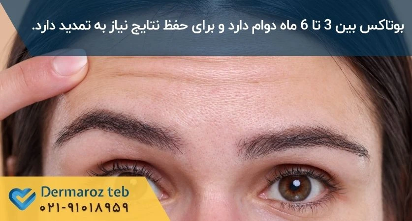 ماندگاری بوتاکس پیشانی
