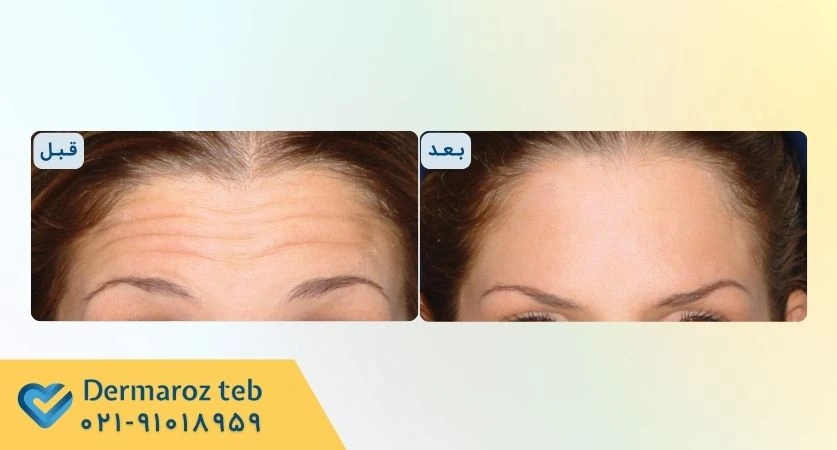 عکس قبل و بعد بوتاکس پیشانی