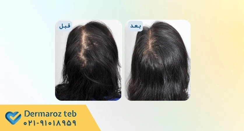 عکس قبل و بعد prp مو