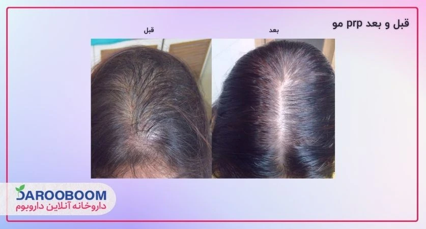 عکس قبل و بعد پی آر پی مو