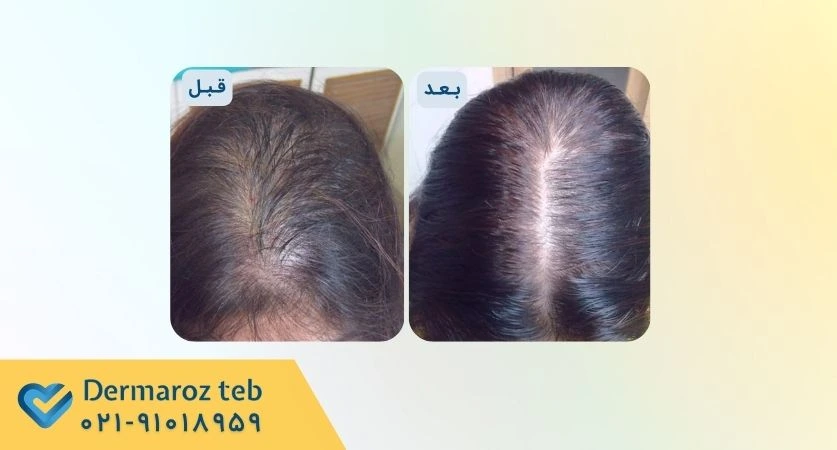 عکس قبل و بعد پی ار پی مو