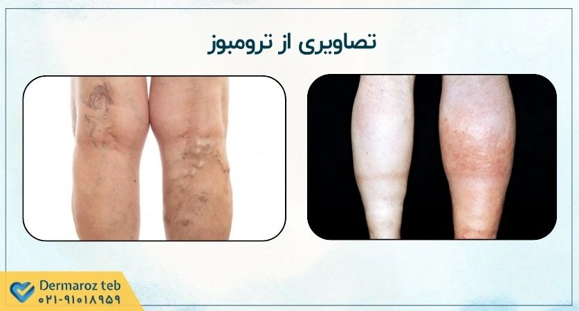 چند نمونه تصویر از ترومبوز